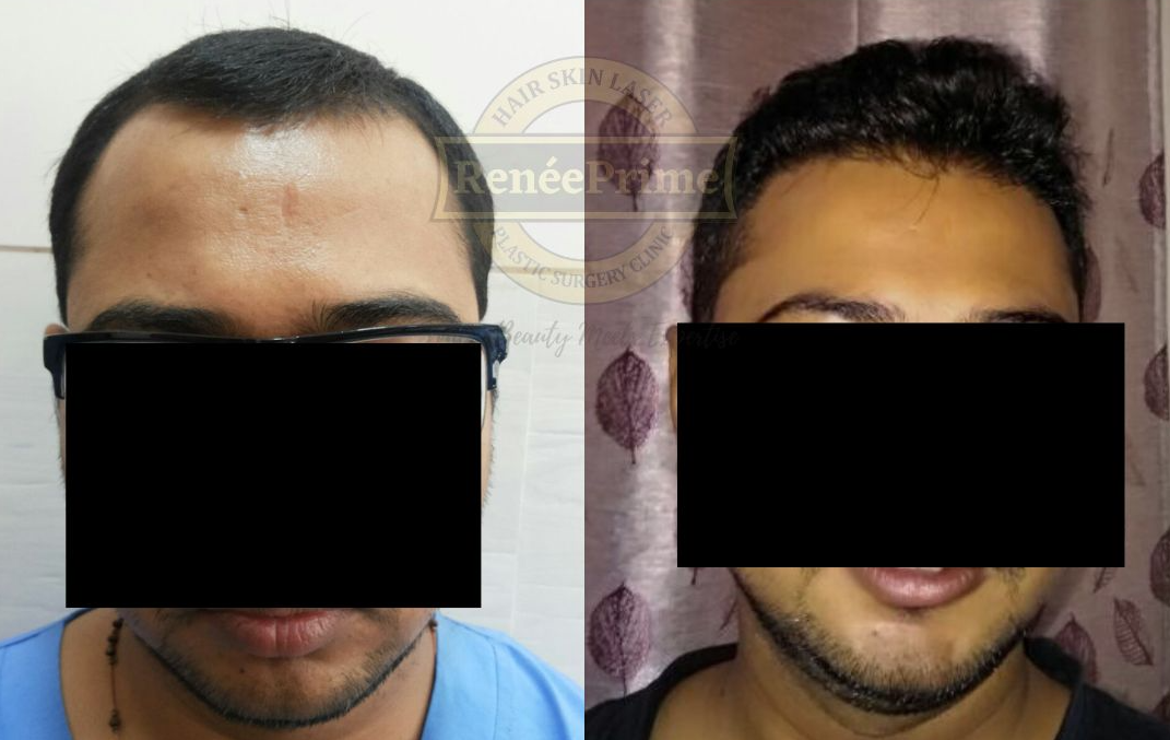 Hair-Transplant-Hairline-Designing.png