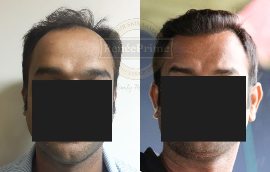 Hair-Transplant-before-after.png