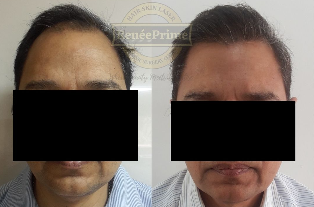 Hair-Transplant-before-and-after-results.png