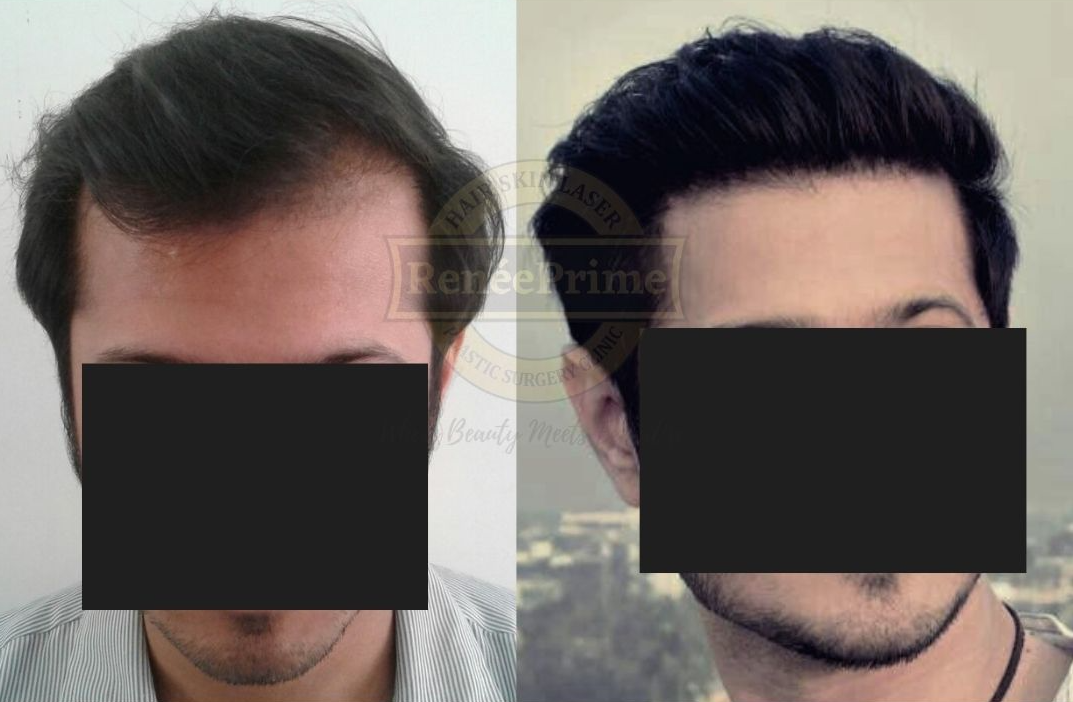 hairline hair transplant in mumbai