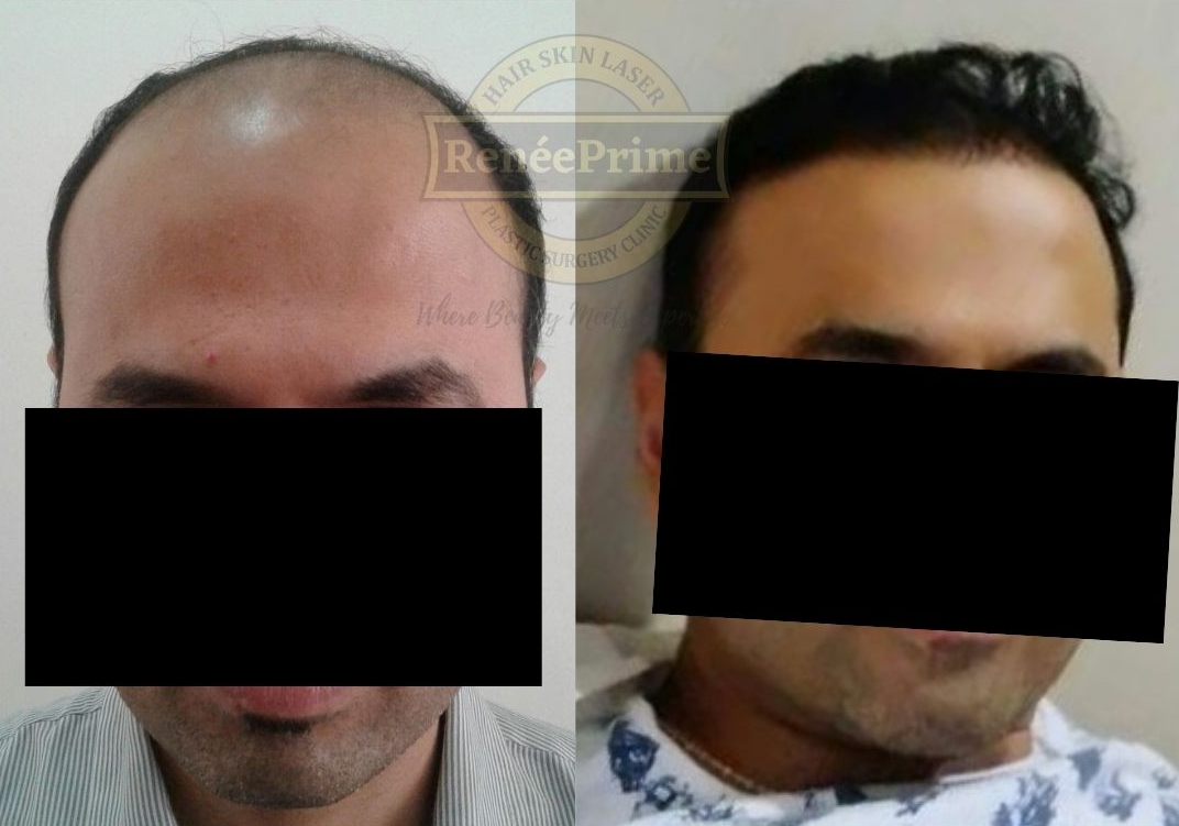 hair-transplant-treatment.png