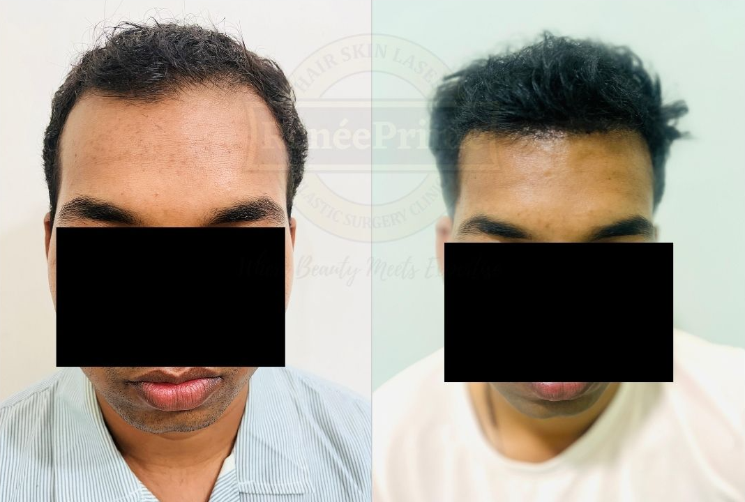 hair transplant results