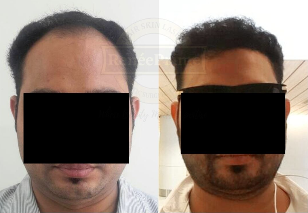 hair transplant cost in mumbai