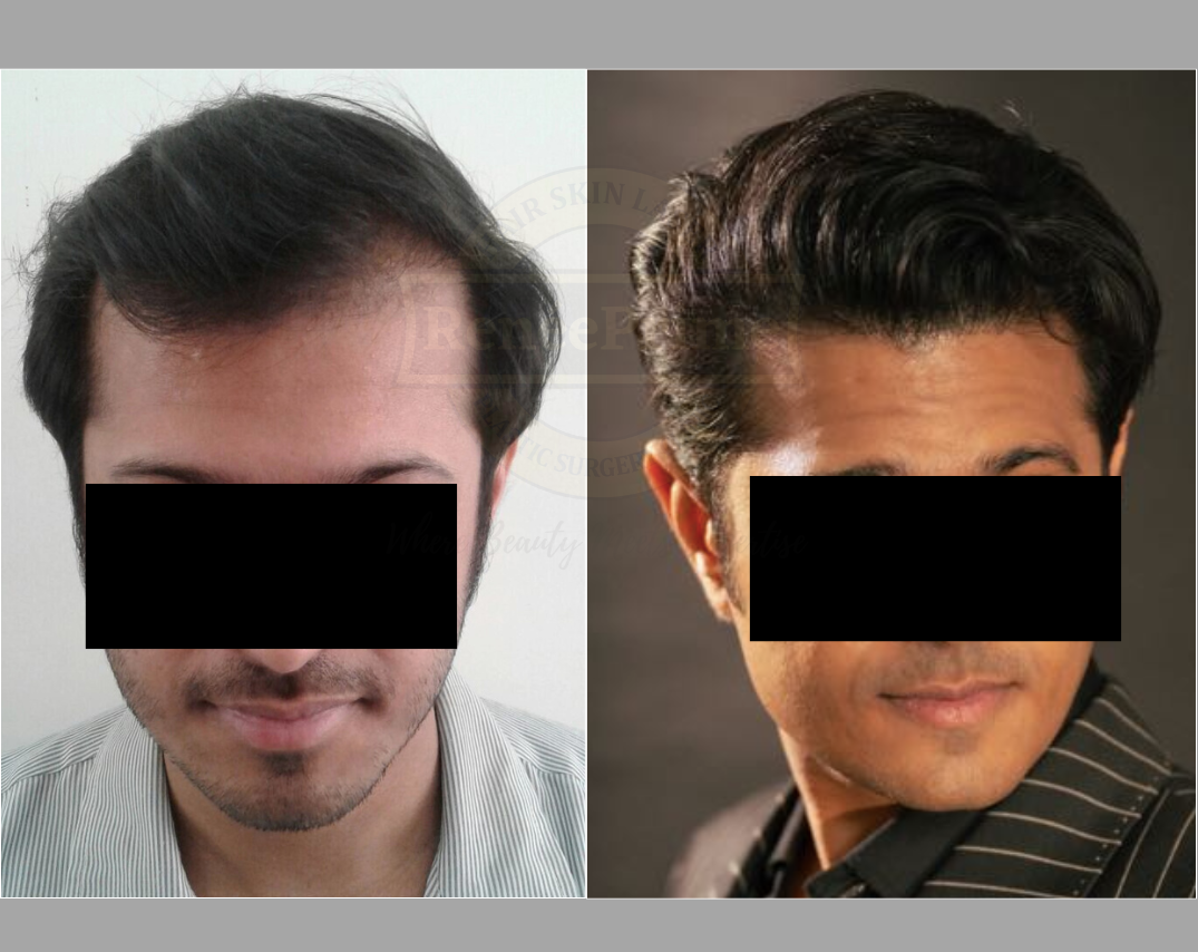 hairline hair transplant at reneeprime clinic, mumbai. Ph 9594715522