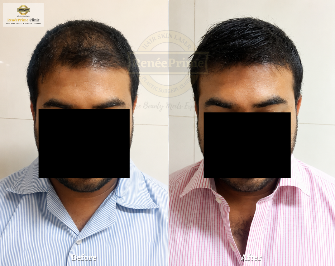 Biofibre Hair Transplant Before and After at ReneePrime Clinic, Mumbai