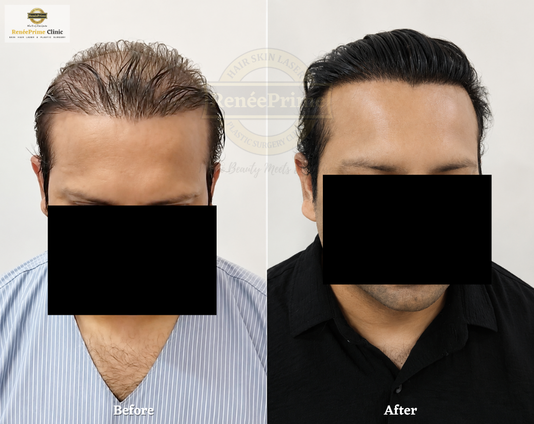 Biofibre Hair Transplant Before and After at ReneePrime Clinic, Mumbai 43