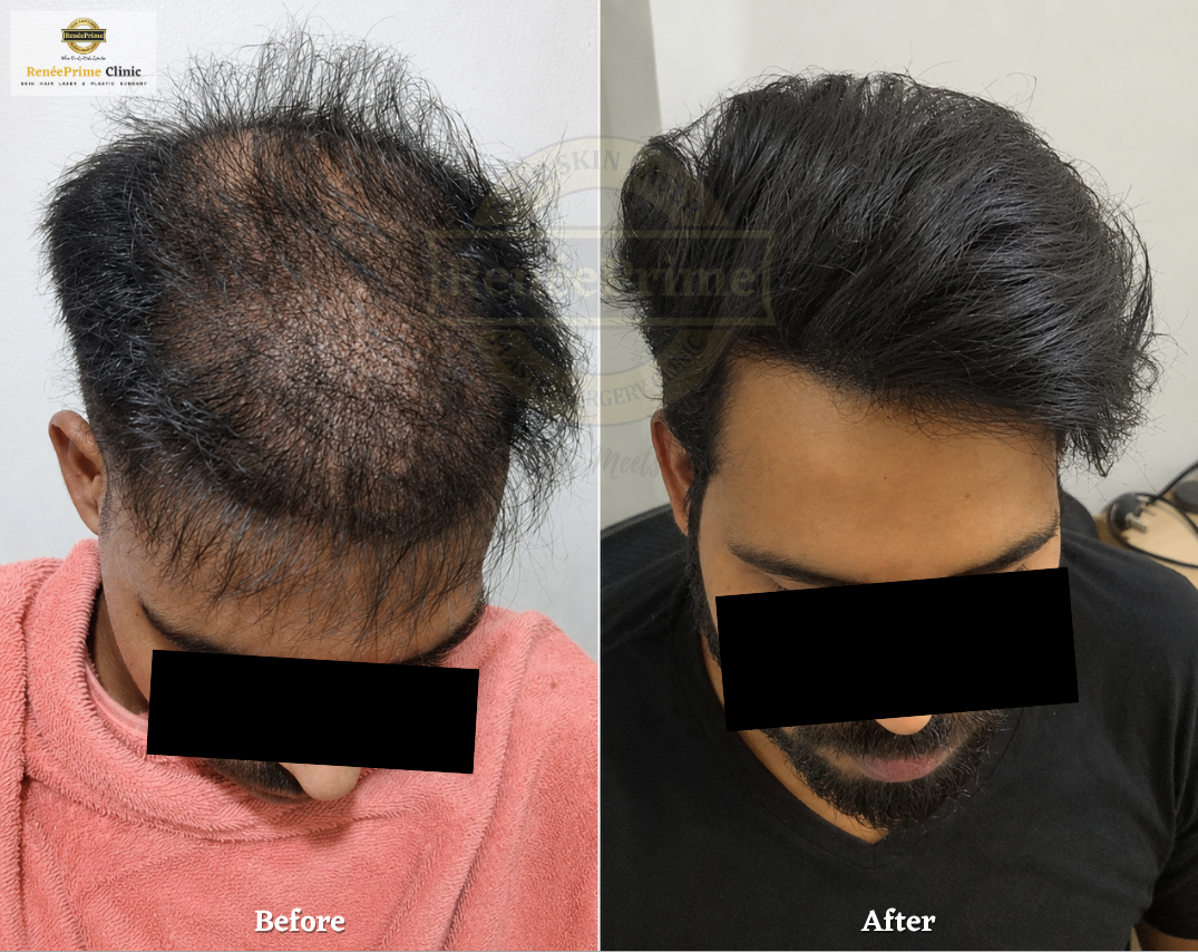 Biofibre Hair Transplant Before and After at ReneePrime Clinic, Mumbai