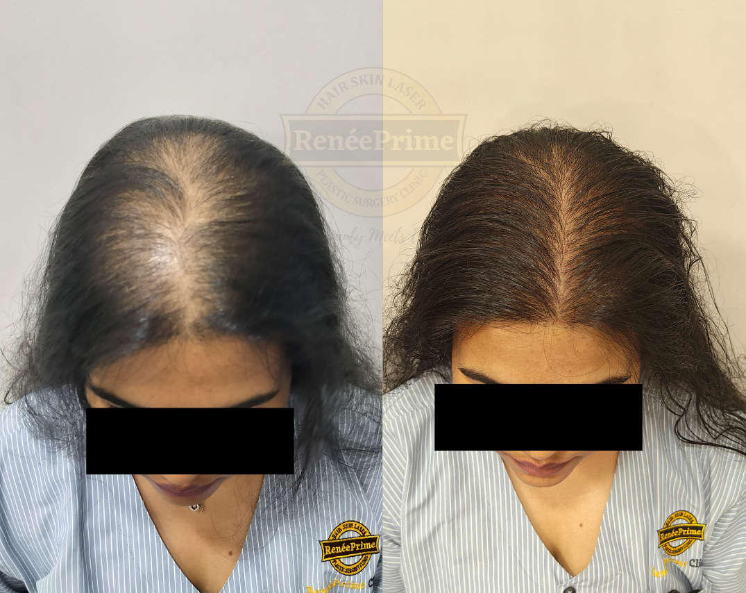 FEMALE Hair loss treatment before and after at ReneePrime Clinic Mumbai by Dr Sulochana Khogare