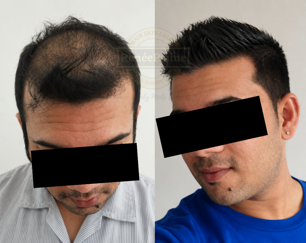 GFC hair therapy Hair loss treatment before and after at ReneePrime Clinic Mumbai by Dr Sulochana Khogare