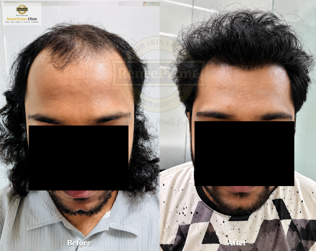 Hair Transplant Before and After at ReneePrime Clinic Mumbai 434