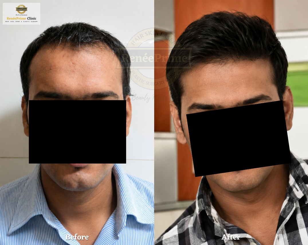 Hair Transplant Before and After at ReneePrime Clinic Mumbai 4523