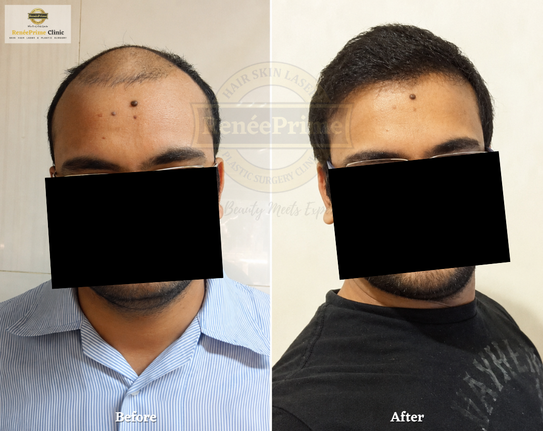 Hair Transplant Before and After at ReneePrime Clinic Mumbai 556