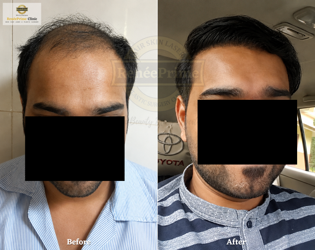 Hair Transplant Before and After at ReneePrime Clinic Mumbai 564