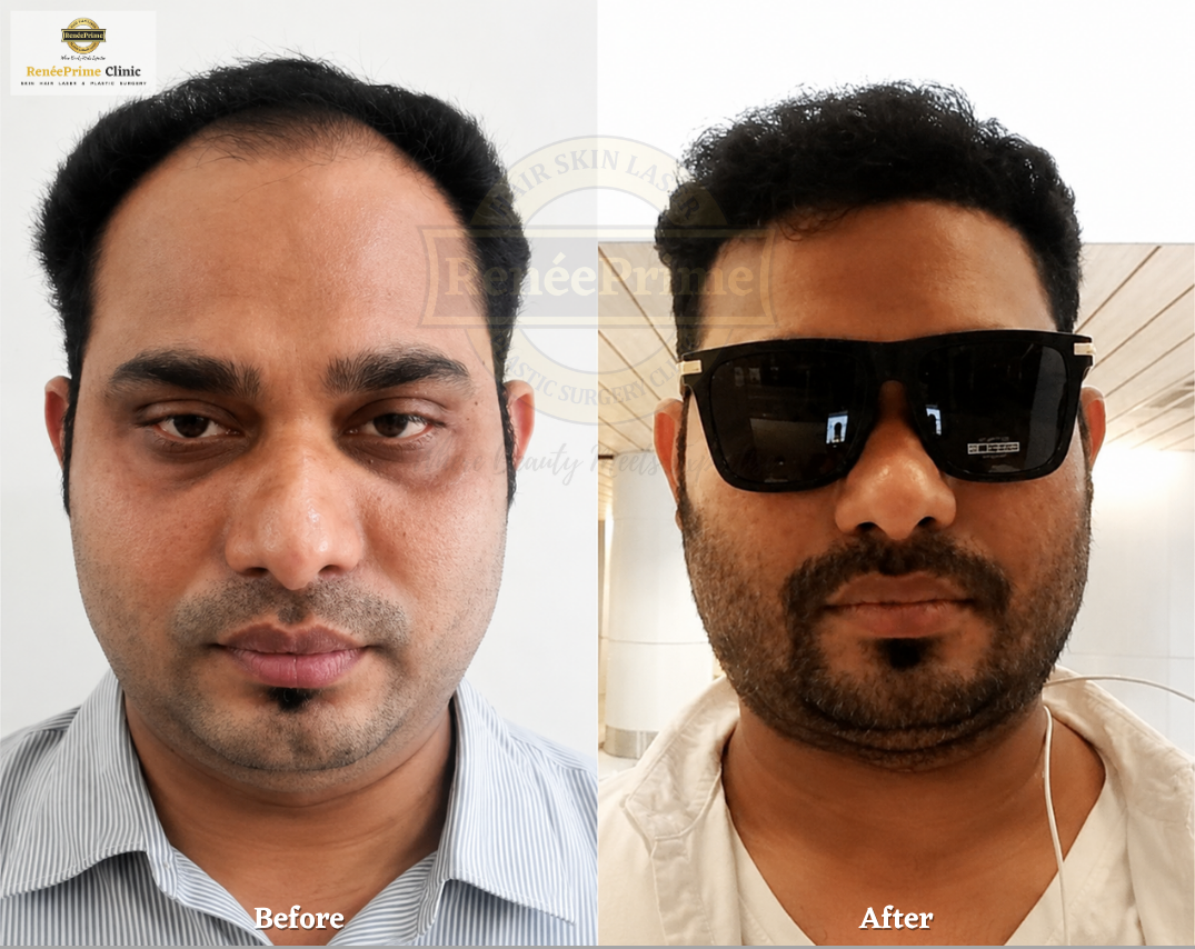 Hair Transplant Before and After at ReneePrime Clinic Mumbai 853