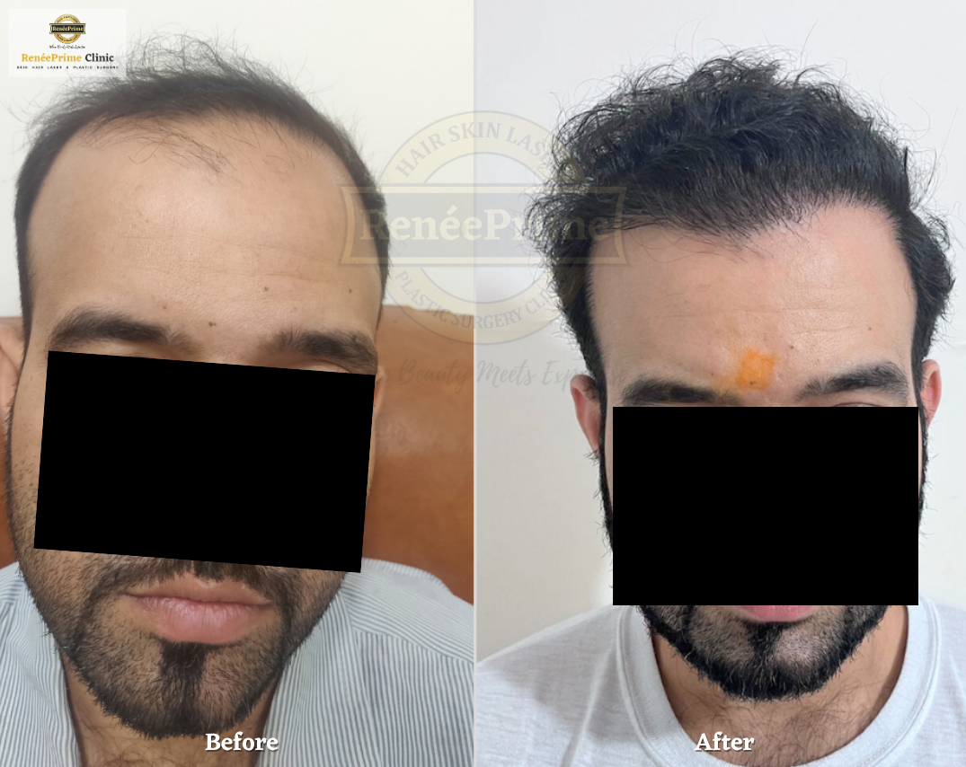 Hair Transplant Before and After at ReneePrime Clinic Mumbai 98