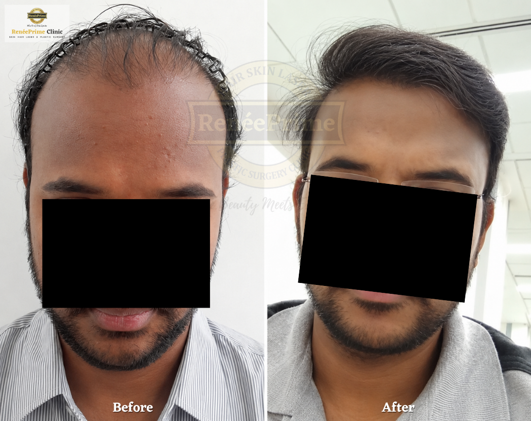 Hair Transplant Before and After at ReneePrime Clinic Mumbai e34