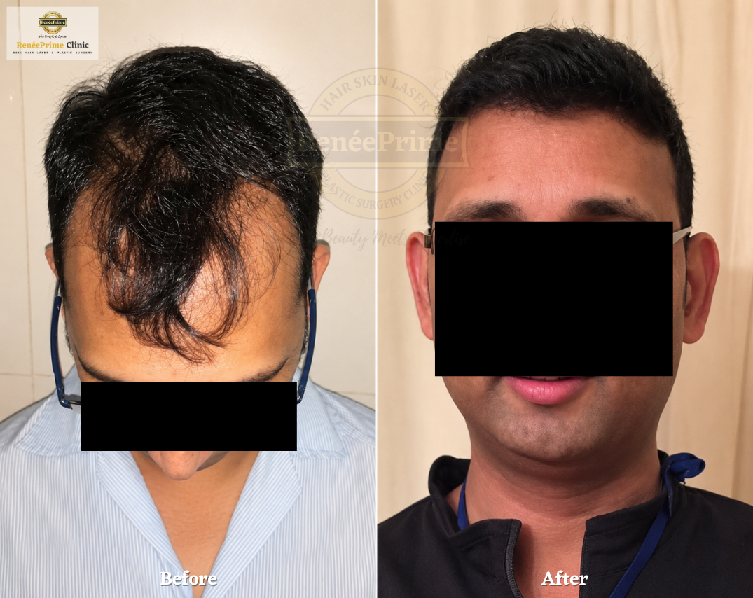 Hair Transplant Before and After at ReneePrime Clinic Mumbai erw