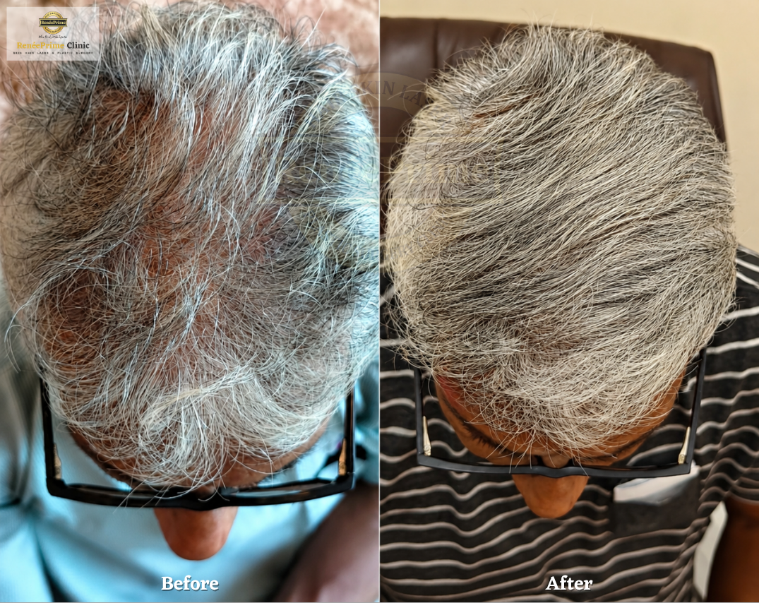 Hair Treatment Before and After at ReneePrime Clinic Mumbai