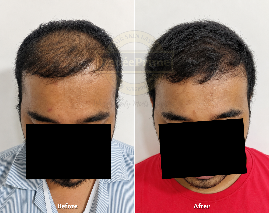 Hair Treatment Before and After at ReneePrime Clinic Mumbai 324