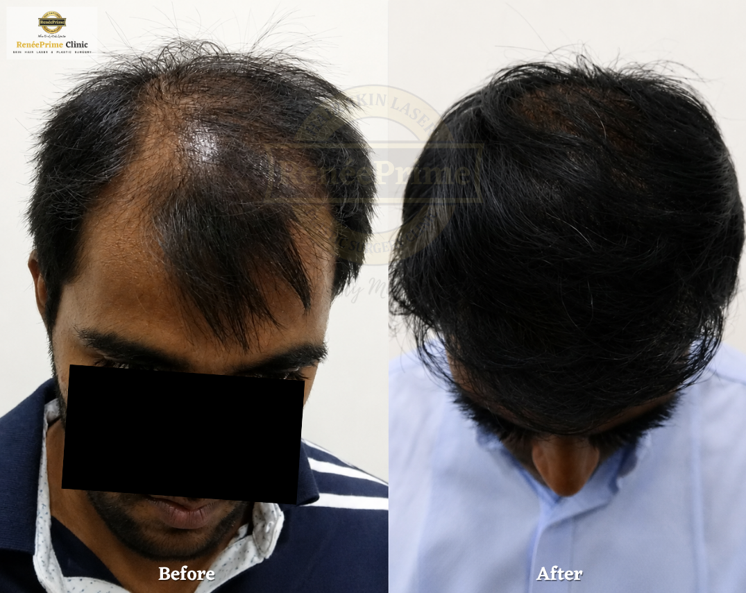 Hair Treatment Before and After at ReneePrime Clinic Mumbai 545