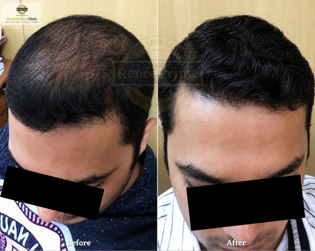 Hair Treatment Before and After at ReneePrime Clinic Mumbai e342