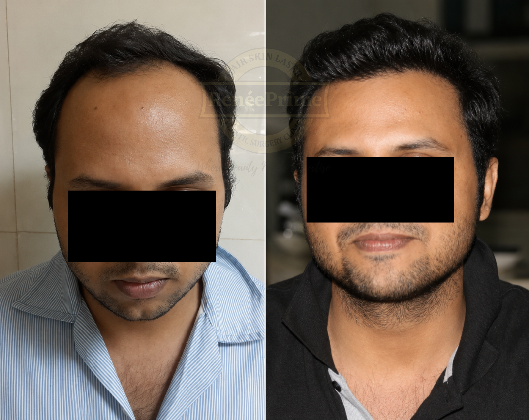Hair loss treatment before and after at ReneePrime Clinic Mumbai by Dr Sulochana Khogare HAIRLINE HAIR TRANSPLANT
