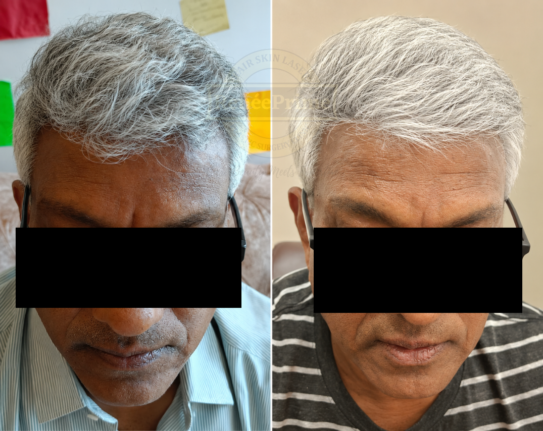 Hair loss treatment before and after at ReneePrime Clinic Mumbai by Dr Sulochana Khogare PRP GFC