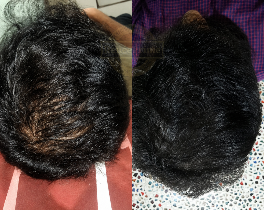 Hair loss treatment before and after at ReneePrime Clinic Mumbai by Dr Sulochana Khogare bfh