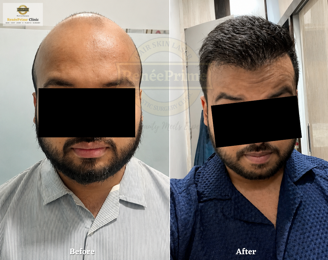 body hair transplant in mumbai before and after results