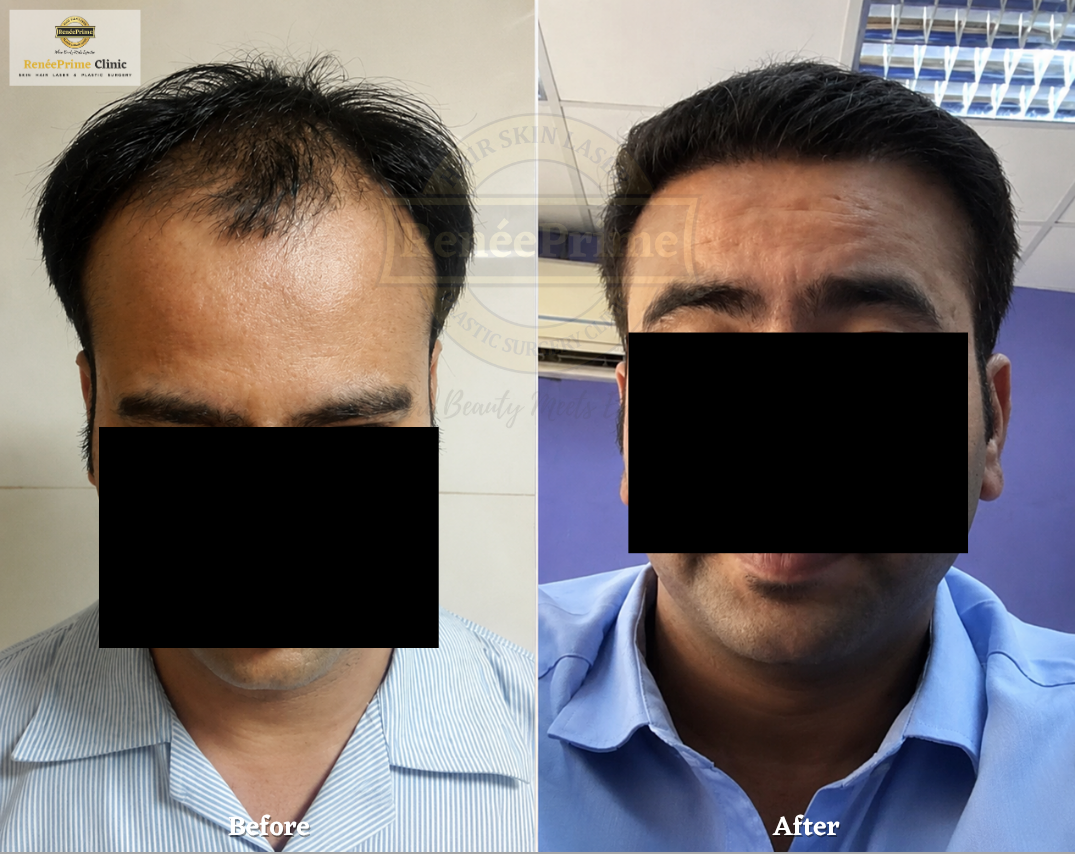 hairline Hair Transplant Before and After at ReneePrime Clinic Mumbai 3u3